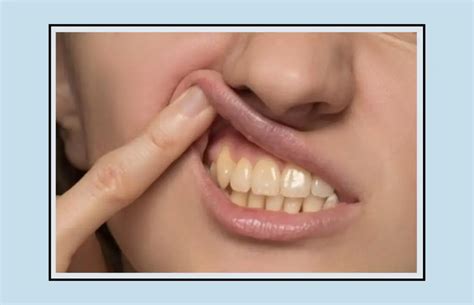 Overbite Vs Underbite - Causes and Treatment Options - Oral Health Line