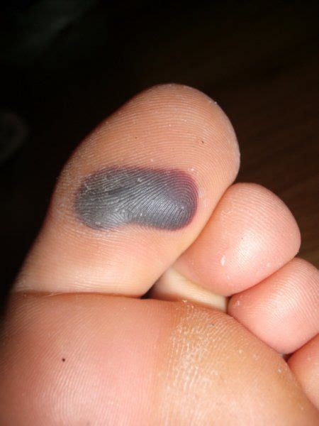 Effective Remedies for Blood Blisters