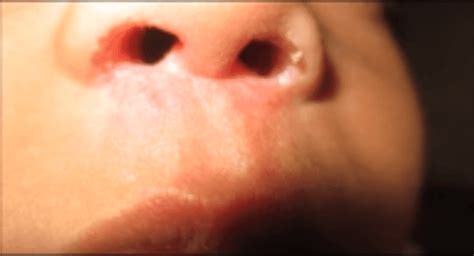 Nasal Vestibulitis - Nasal vestibulitis causes, symptoms, complications ...