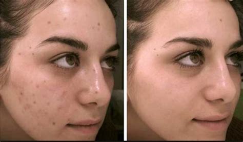 Dark Spots on Face Causes and Removal Ways - Skincarederm