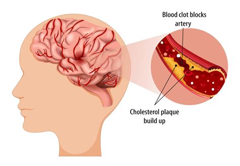 Treatment Advances for Common Cause of Ischemic Stroke - Cedars-Sinai Pulse