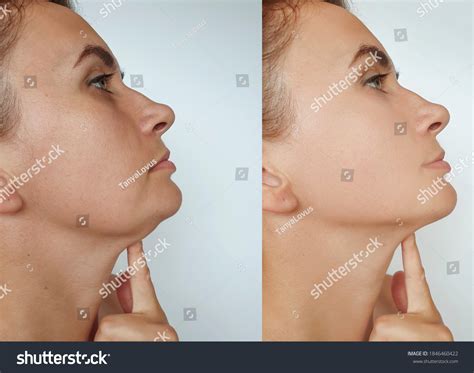 Woman Double Chin Before After Treatment Stock Photo 1846460422 ...