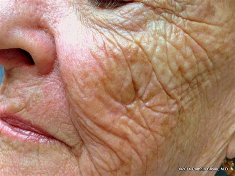 Aging Skin – BASUK DERMATOLOGY