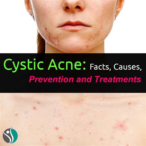 Cystic Acne: Facts, Causes, Prevention, and Treatments | Consumer ...