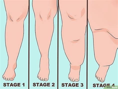 Understand the stages of lipedema. As with many disorders and diseases ...