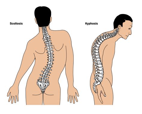 Achondroplasia: MedlinePlus Genetics