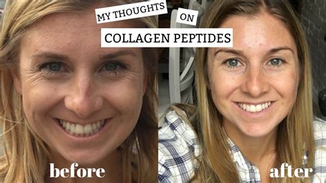 Mothlhtqqjbpqdp: Collagen Powder Before And After Pics