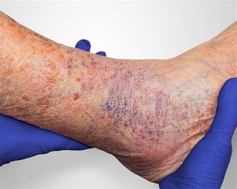 Venous Leg Ulcers: What Are the Treatment Options? | Vein Center in ...