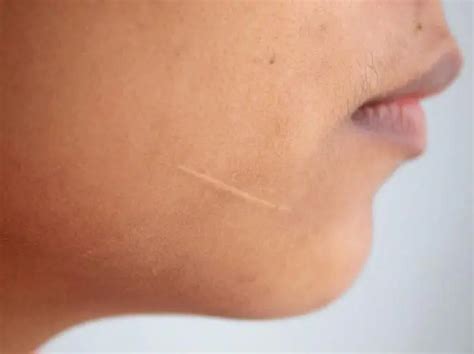 Scars - what is it? Causes and treatments for scars | Diseases and ...