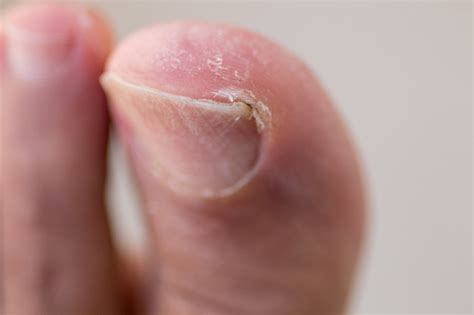 Ingrown Toenail or Onychophosis? | Croydon Total Footcare