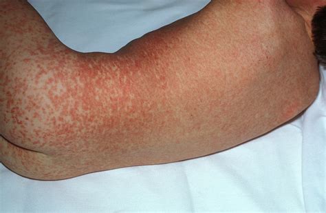 Measles Rash