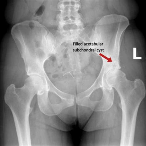 Hip Cysts | Acetabular Paralabral Cyst & Subchondral Cyst | FAI ...