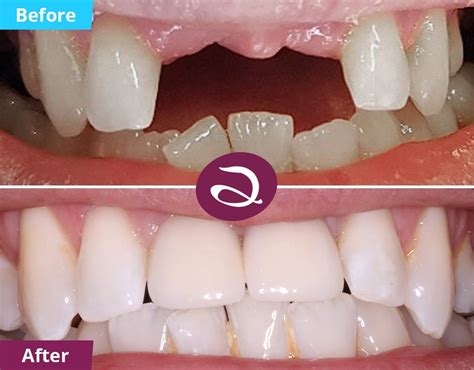 Transform Your Smile with Cosmetic Dentistry at Aspects Dental Clinic ...