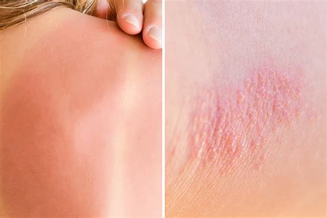 Heat Rash Between Legs | Mum and Babies