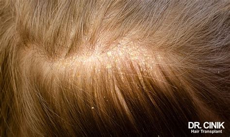 Scabs And Soreness on the Scalp: 11+1 Reasons