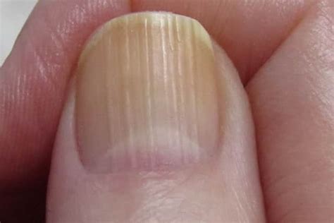 What Causes Lines In Fingernails - Design Talk