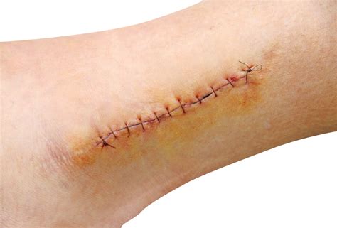 When Does a Cut Need Stitches? | Complete Care