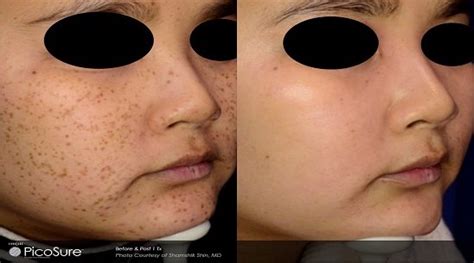 Getting Rid of Dark Spots On Your Face | O'Neill Plastic Surgery