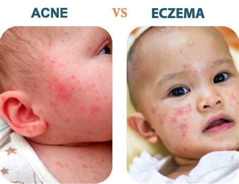 Baby Acne vs. Eczema: Understanding The Difference