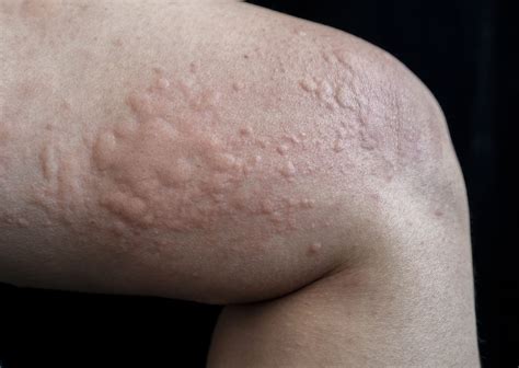 Hives Treatment In Singapore | By Dr Lee Hwee Chyen