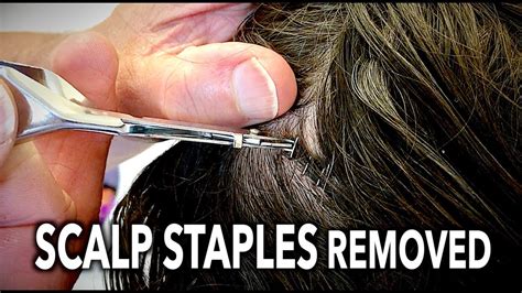 SCALP STAPLES REMOVED (quick & mostly painless) | Dr. Paul - YouTube