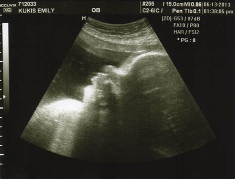 Gracie Ann: Ultrasound update -35 weeks