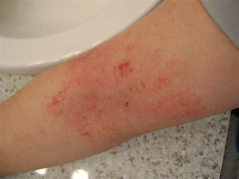 rashes in elbow creases - pictures, photos