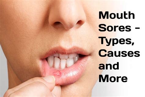 Mouth Sores - Types, Causes and More