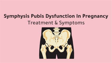 Symphysis Pubis Dysfunction SPD In Pregnancy Treatment & Symptoms