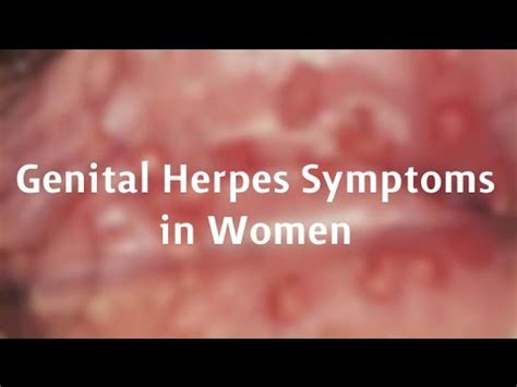 Genital Herpes Symptoms in Women - YouTube