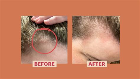 My Scalp Psoriasis Came Out of Nowhere — Here's How I Treated It | Allure