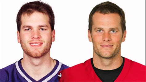 Tom Brady Hair Transplant Scar