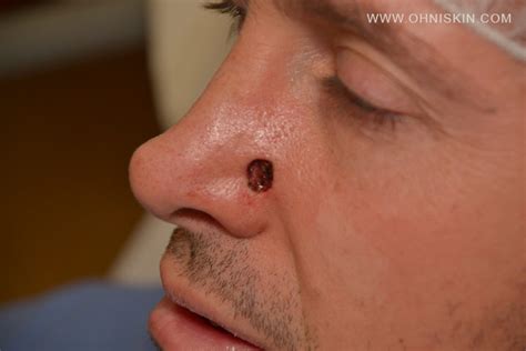 Basal Cell Carcinoma of the Nose and Nasal Reconstruction