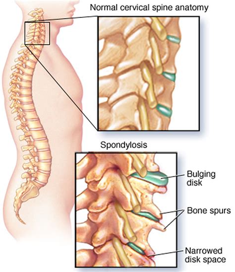 Pinched Nerve - In Neck, Arm, Shoulder - Causes, Symptoms & Treatment