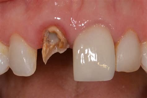 How To Remove A Broken Tooth - Maybe you would like to learn more about ...