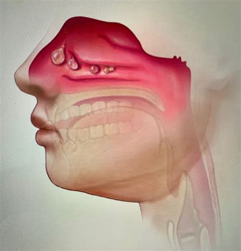 Nasal Polyps: what can I do, Doc?