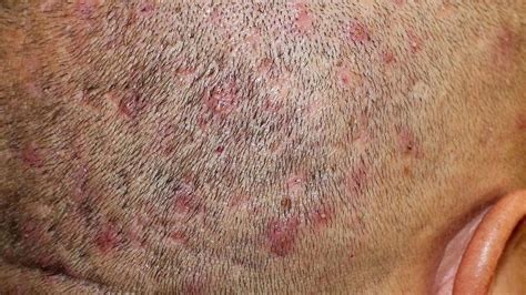 Scalp scab: The ideal way to deal with it