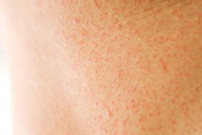 Heat Rash When Should I See A Doctor - Riset