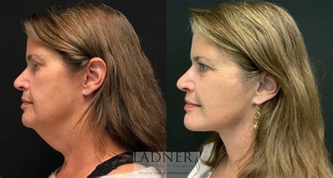 Facelift / Neck Lift Before and After Pictures Case 112 | Denver, CO ...