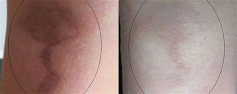 Burn Scar Laser Treatment - Connecticut Skin Institute