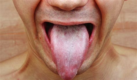 What Are the Causes of Tongue Fungus? | Livestrong.com