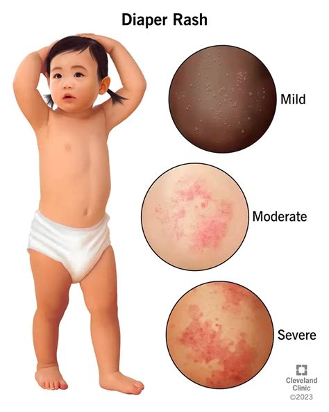 Causes of Diaper Rash | Understanding Irritation in Babies