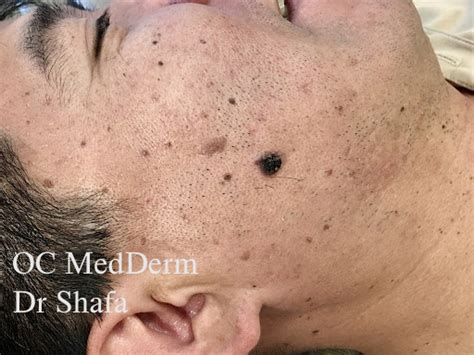 Skin Biopsy Procedure at OC MedDerm | Irvine & Orange County Dermatology