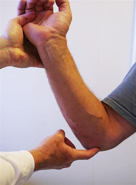 Ulnar Nerve Entrapment at the Elbow (Cubital Tunnel Syndrome ...