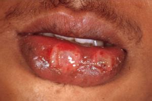 Derm Dx: A single chancre progresses to a diffuse rash - Clinical Advisor