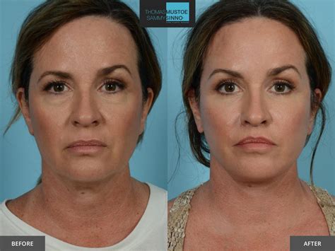 8 Facelift Before-and-After Photos That Prove Just How Natural Today’s ...