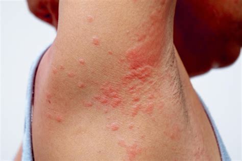 allergy rash of dermatitis problem. skin problem from drug allergy ...