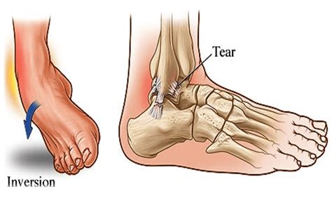 Sprained Ankle Bruising On Side Of Foot Shop | emergencydentistry.com