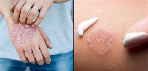 Eczema vs Ringworm: Symptoms, Treatments, and When to Seek Care ...