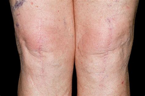 Total Knee Replacement Scars Photograph by Dr P. Marazzi/science Photo ...